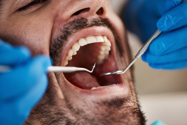 Best Emergency Treatment for Oral Infections in Sunnyvale, CA