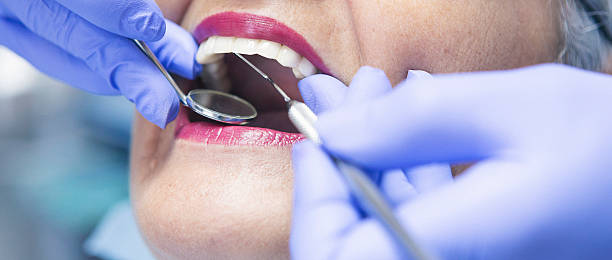 Best Broken or Chipped Tooth Repair in Sunnyvale, CA